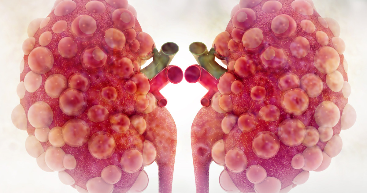 What Causes Polycystic Kidney Disease—and How You Can Control It