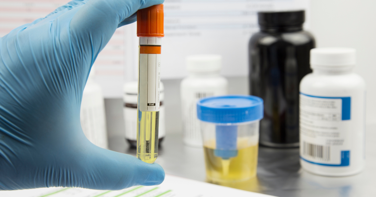 What Is a Urine Albumin-Creatinine Ratio and Why Do You Need to Know?